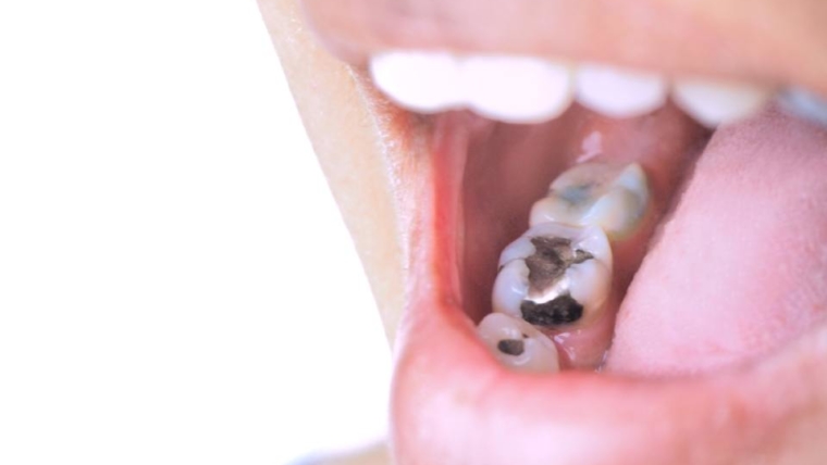 Koliko su štetni dentalni amalgami (plombe)?
