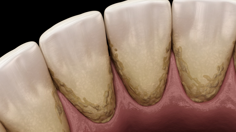 Čišćenje zubnog kamenca – važan čimbenik za oralno zdravlje