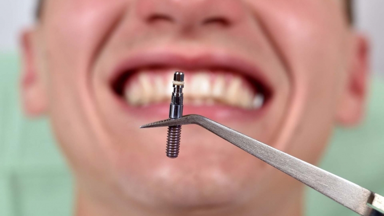 Odbacivanje zubnih implantata – što morate znati i kako djelovati?